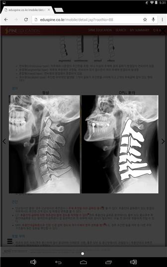 척추 질환 교육 사이트 개설